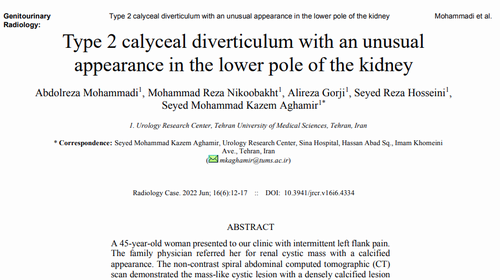 Type 2 calyceal diverticulum with an unusual appearance in the lower pole of the kidney
